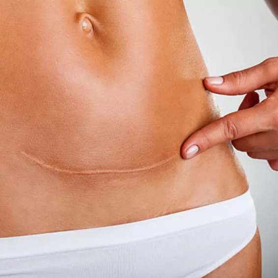 Cicatrices faciales y corporales