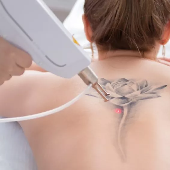 Eliminación de tatuajes