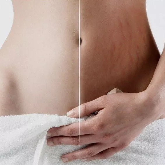 Phi-ion, eliminación estrías