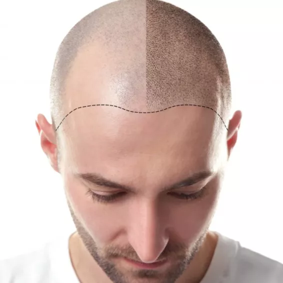 Tricopigmentación Capilar